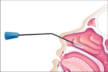 turbinate coblation is an effective treatment for nasal obstruction and can help relieve allergy symptoms, snoring and sleep apnea